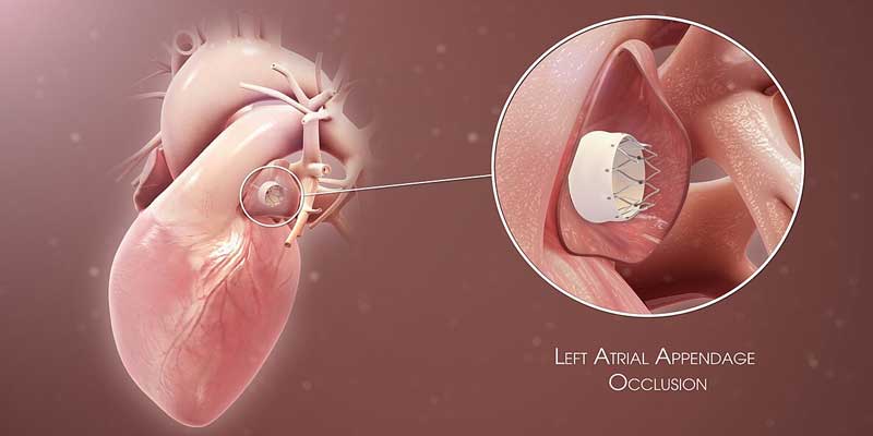 PTMC Balloon Mitral Valvotomy