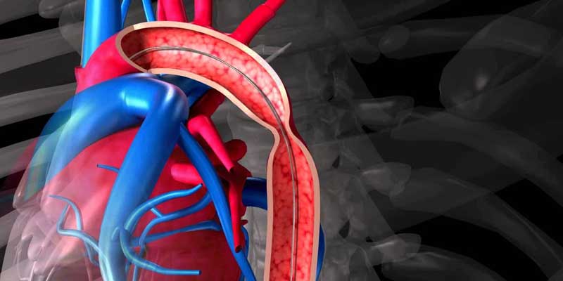 Coarctation of Aorta Stenting