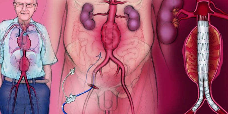 Thoracic Endovascular Aortic Repair