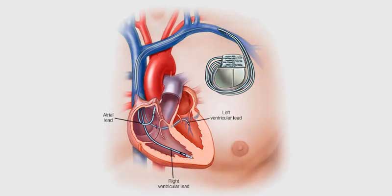 Permanent Pacemaker Implantation