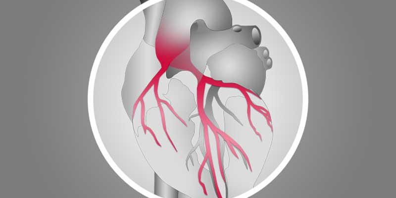 Complex Left Main and Multivessel PCI