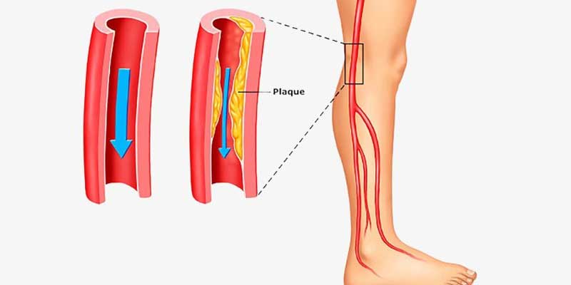 Peripheral Angiography