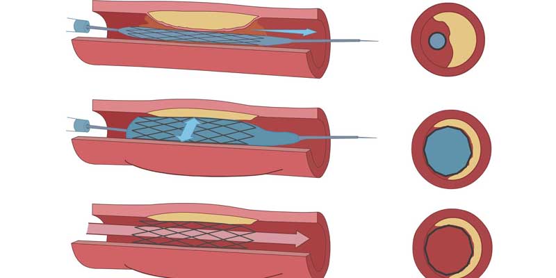 Peripheral Angioplasty PTA Lower Limbs