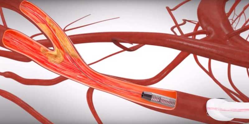 Renal Artery and Carotid Artery Stenting