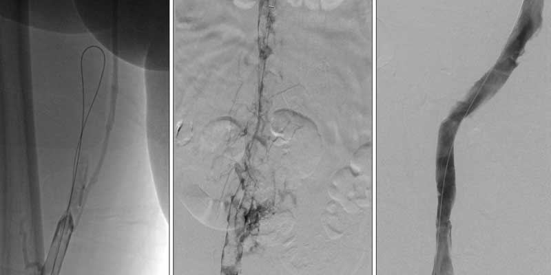 IVC Filter and Pulmonary Artery Mechanical Thrombectomy