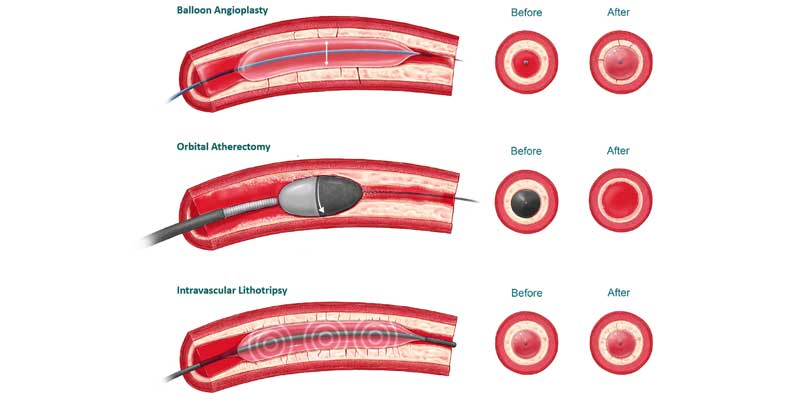 Rotablation Orbital Atherectomy IVL