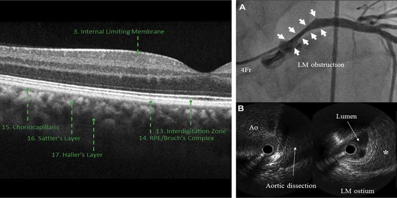IVUS OCT Imaging