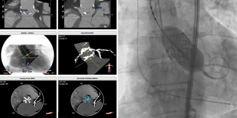 Hemodynamic Support Assisted High Risk PCI