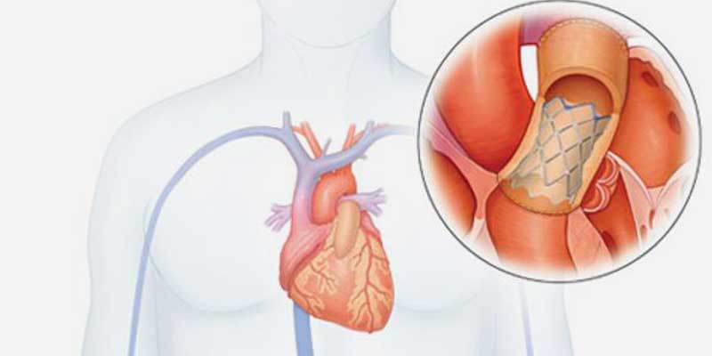 Transcatheter Pulmonary Valve Replacement